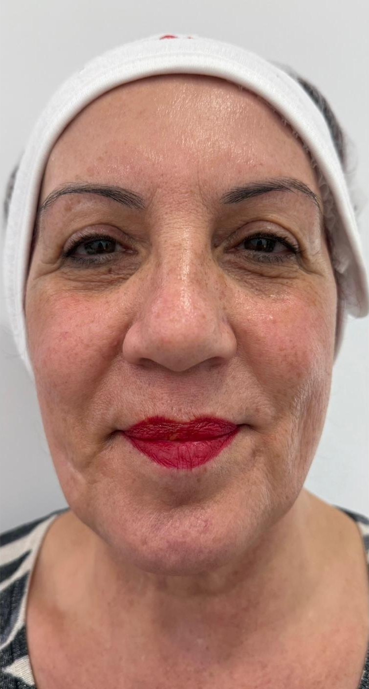 Before: Full-face refresh